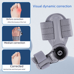 Upgraded Adjustable Bunion Corrector - All The Above